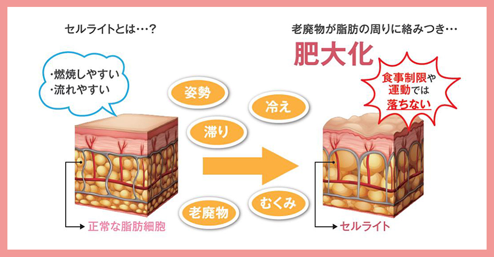 セルライトとは？